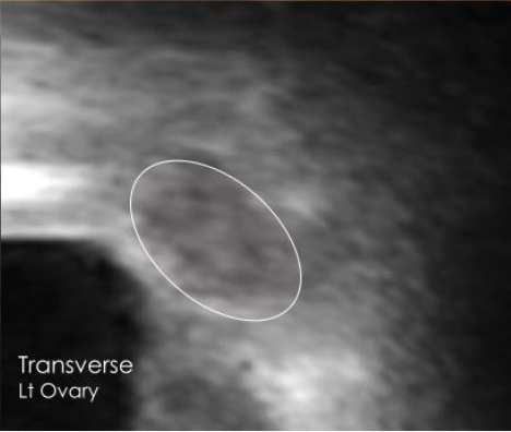 Left ovary transverse view ultrasound